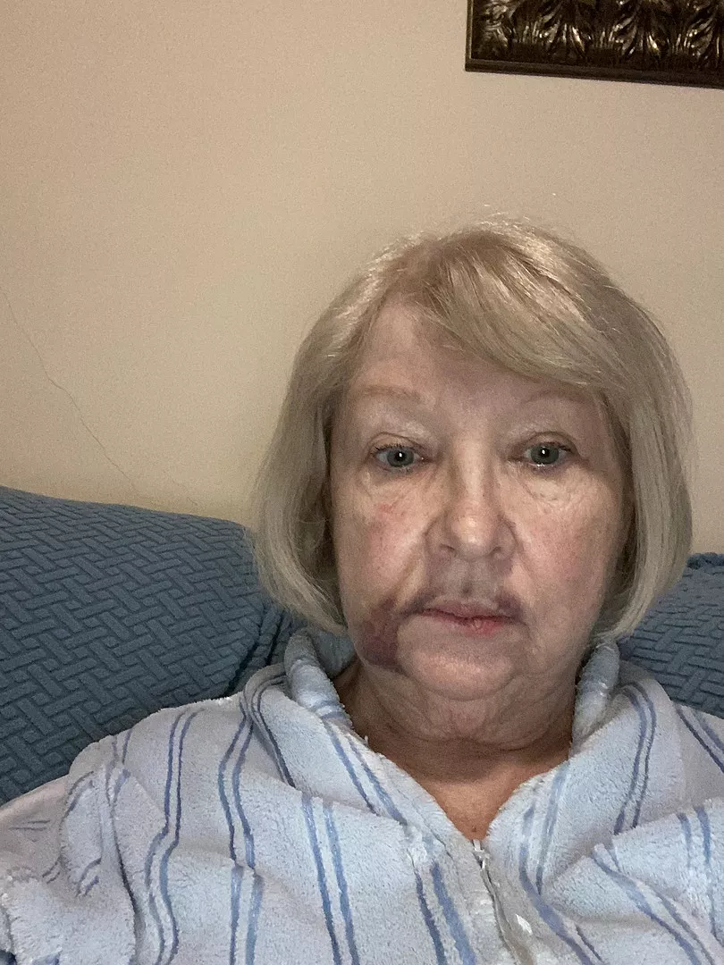 Before - Light skin tone