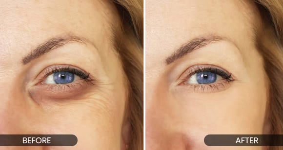 Puffy eyes - before and after