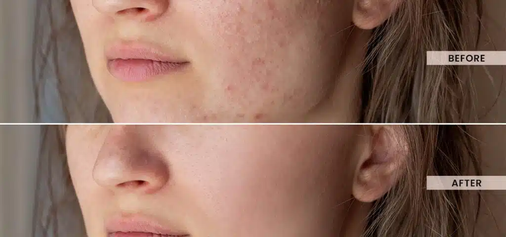 Acne scars before and after