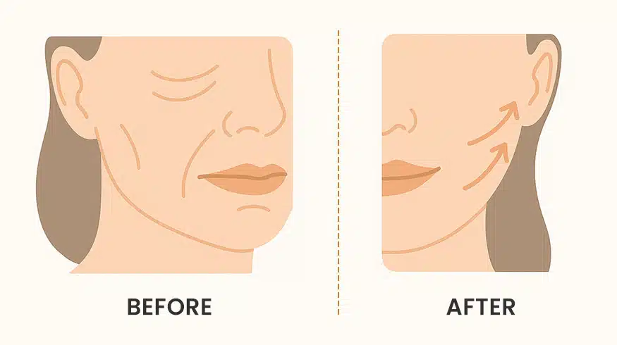 Before and after firming