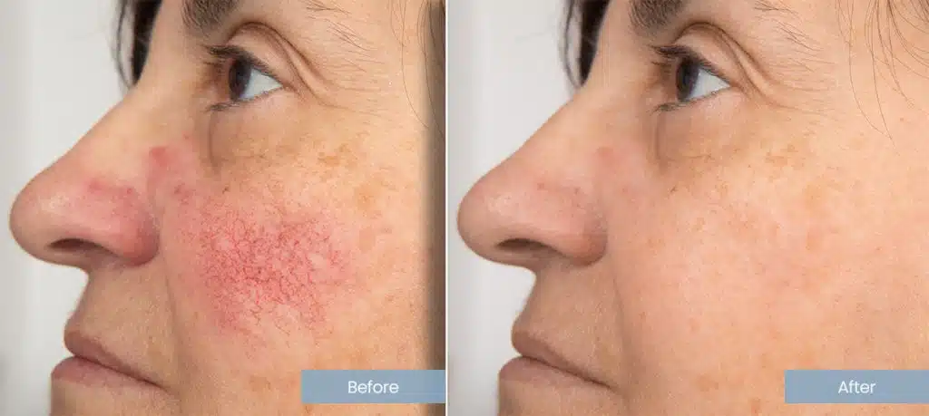 Before after redness