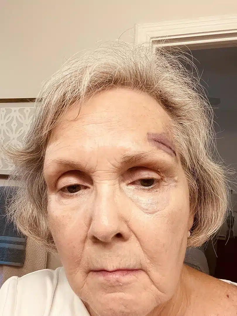 After - Medium skin tone