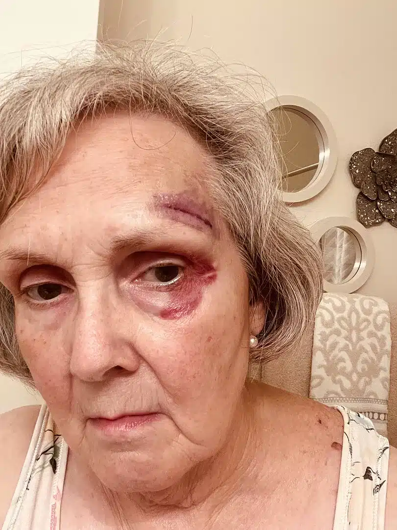 Before - Medium skin tone